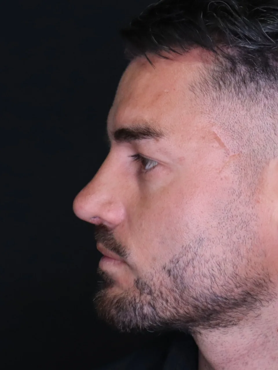 Rinoplastika Zagreb — rezultat nakon zahvata, pacijentica 3 — Poliklinika Malić