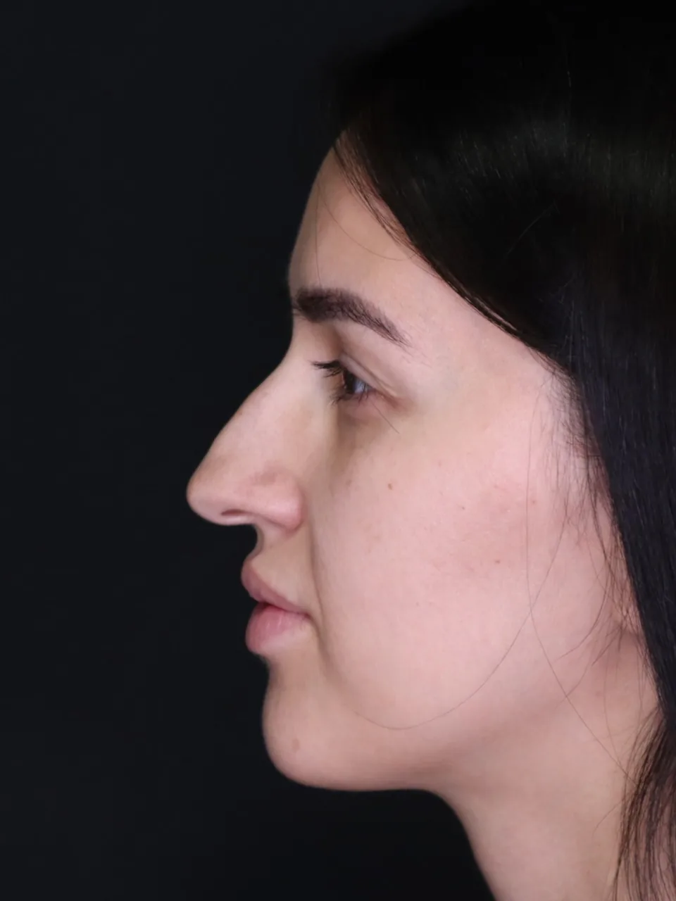 Rinoplastika Zagreb — stanje nosa prije zahvata, pacijentica 2 — Poliklinika Malić