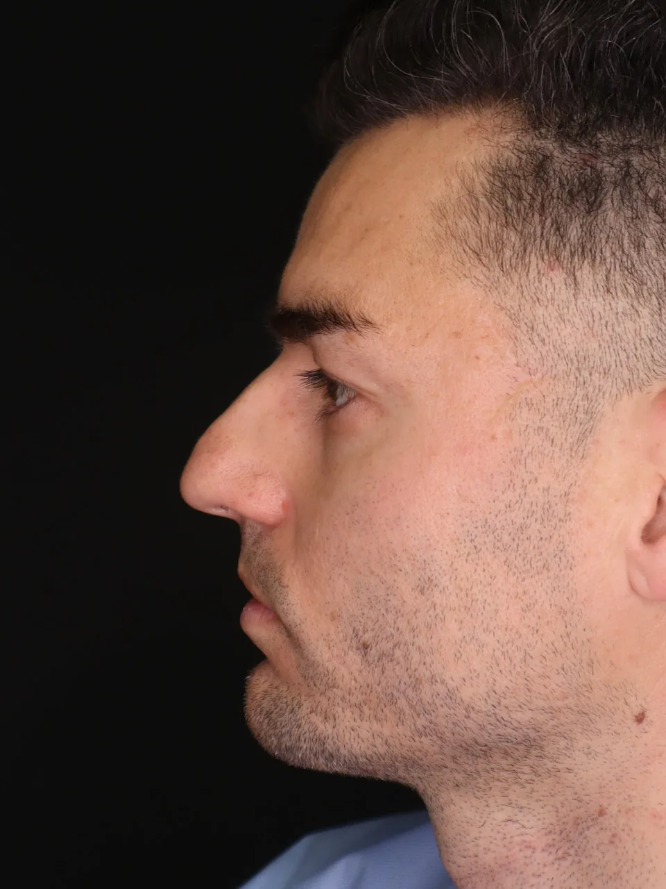 Rinoplastika Zagreb — stanje nosa prije zahvata, pacijentica 3 — Poliklinika Malić
